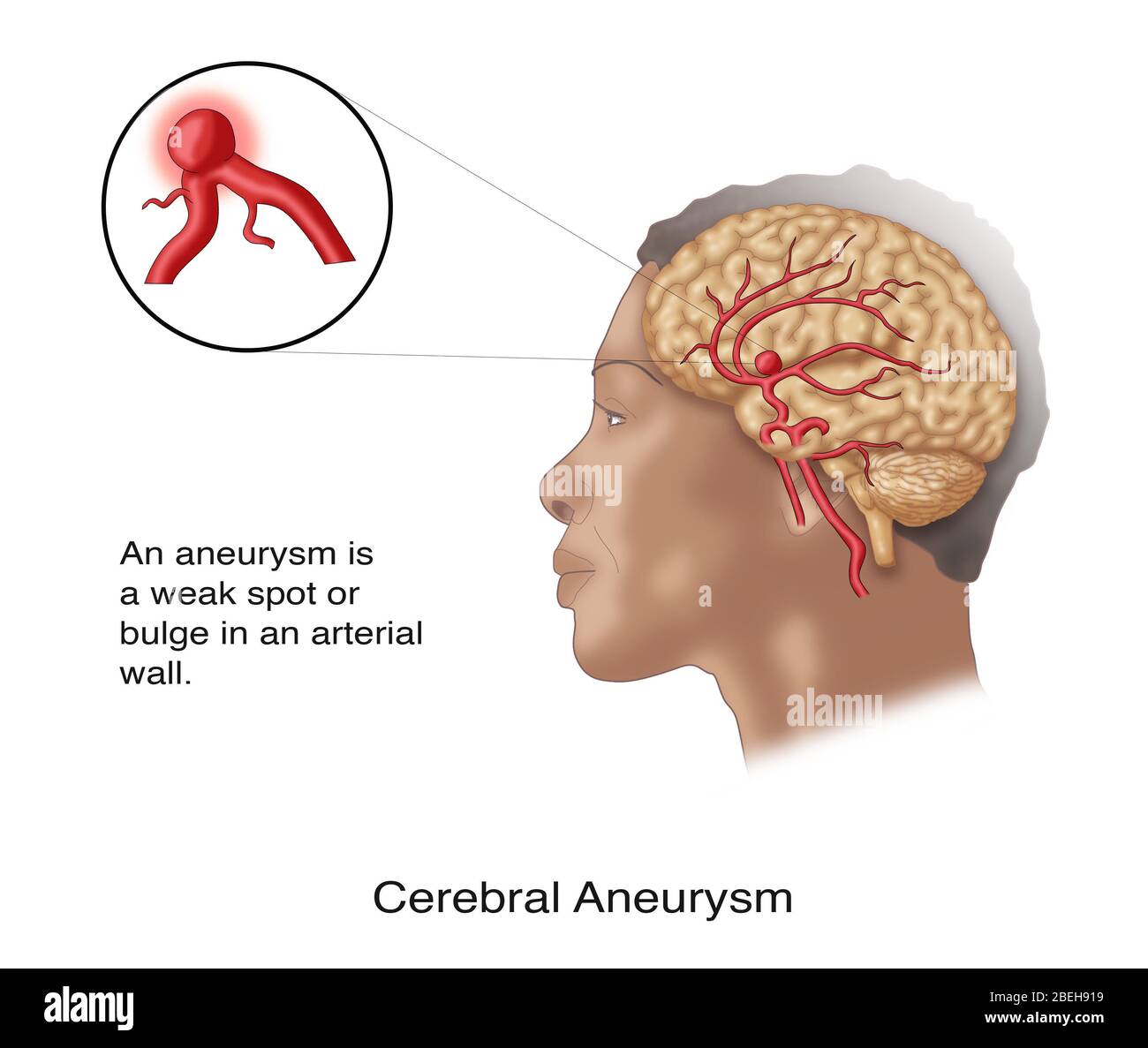 Gehirn Aneurysma in situ Stockfotografie Alamy