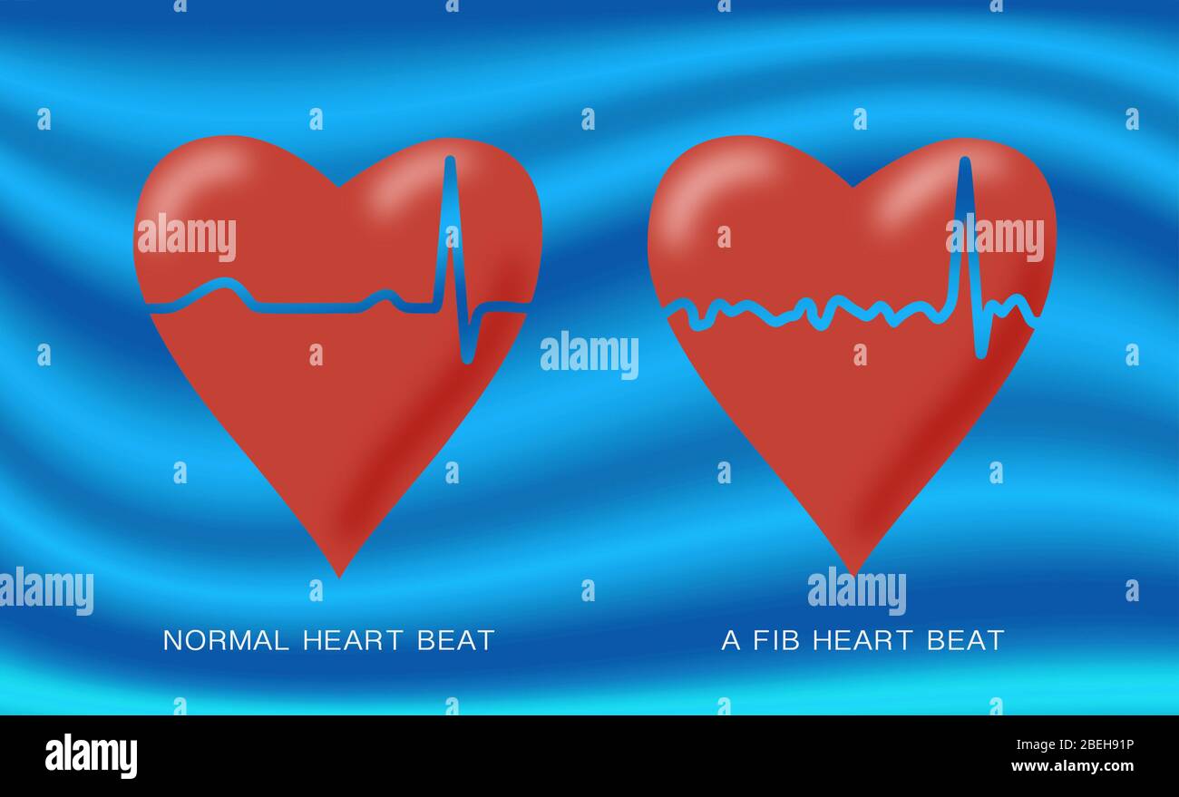 Normale und Afib-Herzschläge, Illustration Stockfoto