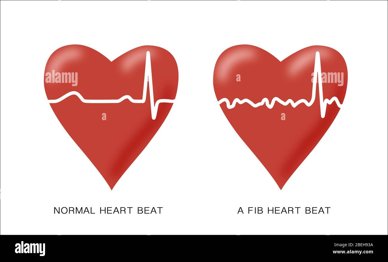 Normale und Afib-Herzschläge, Illustration Stockfoto