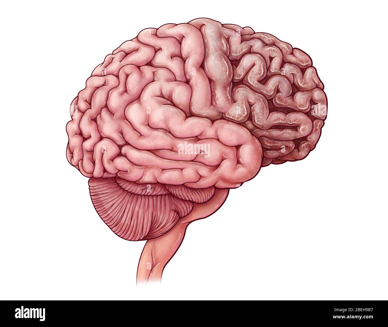 Tay-sachs-Krankheit, Illustration Stockfoto
