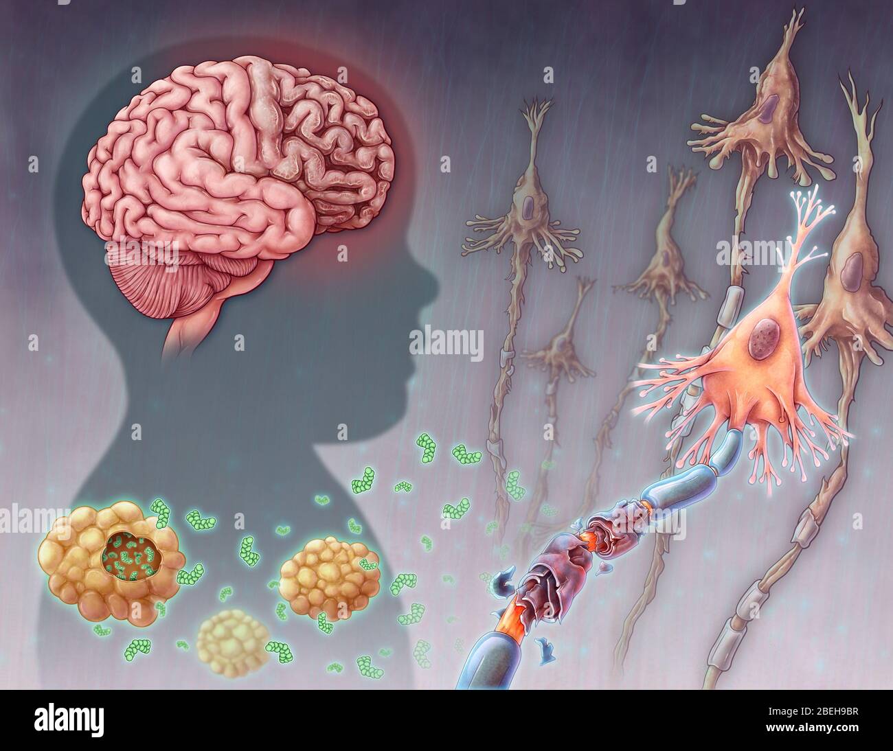 Tay-sachs-Krankheit, Illustration Stockfoto