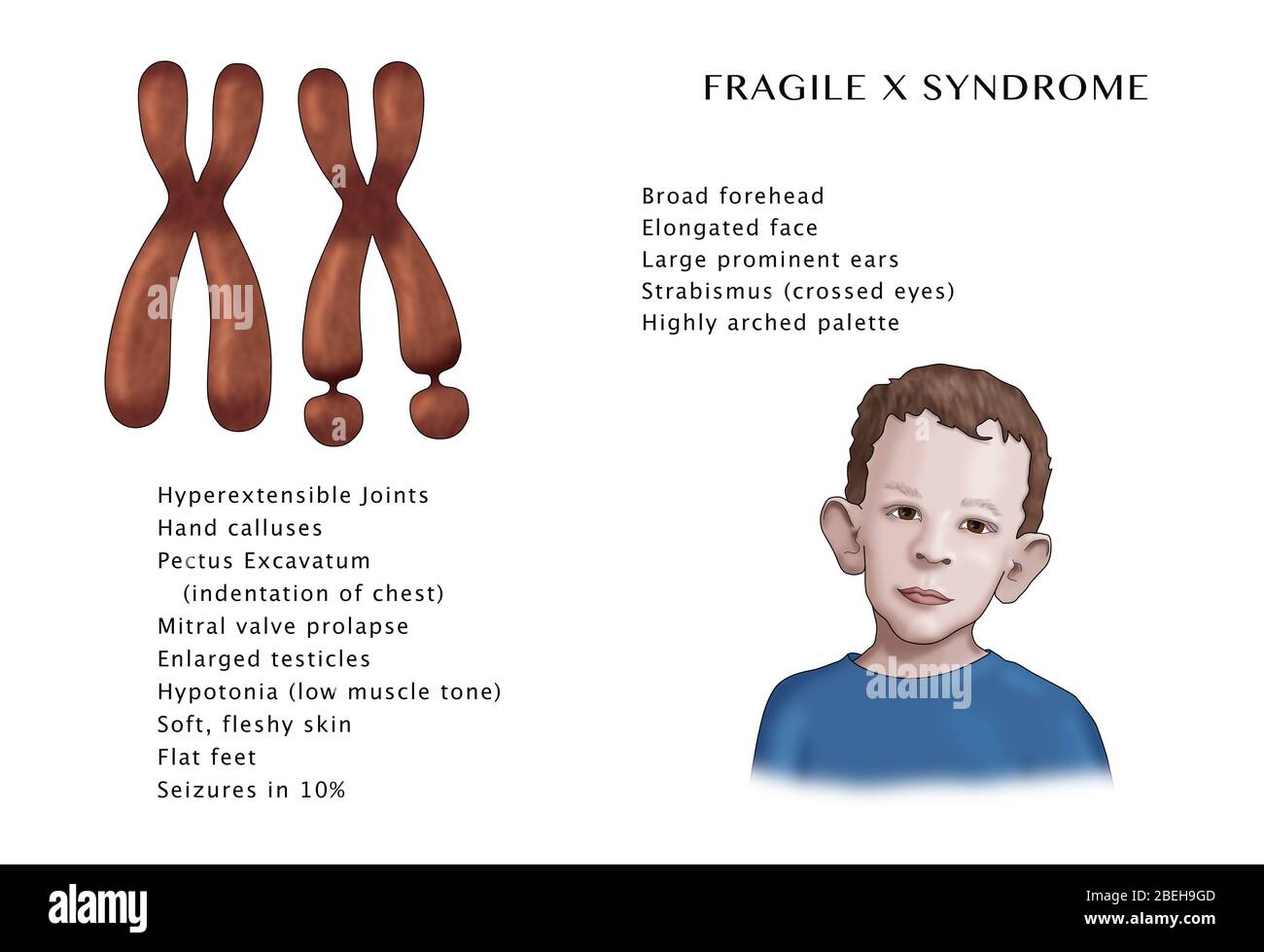 Fragile X-Syndrom Symptome. Abbildung. Stockfoto