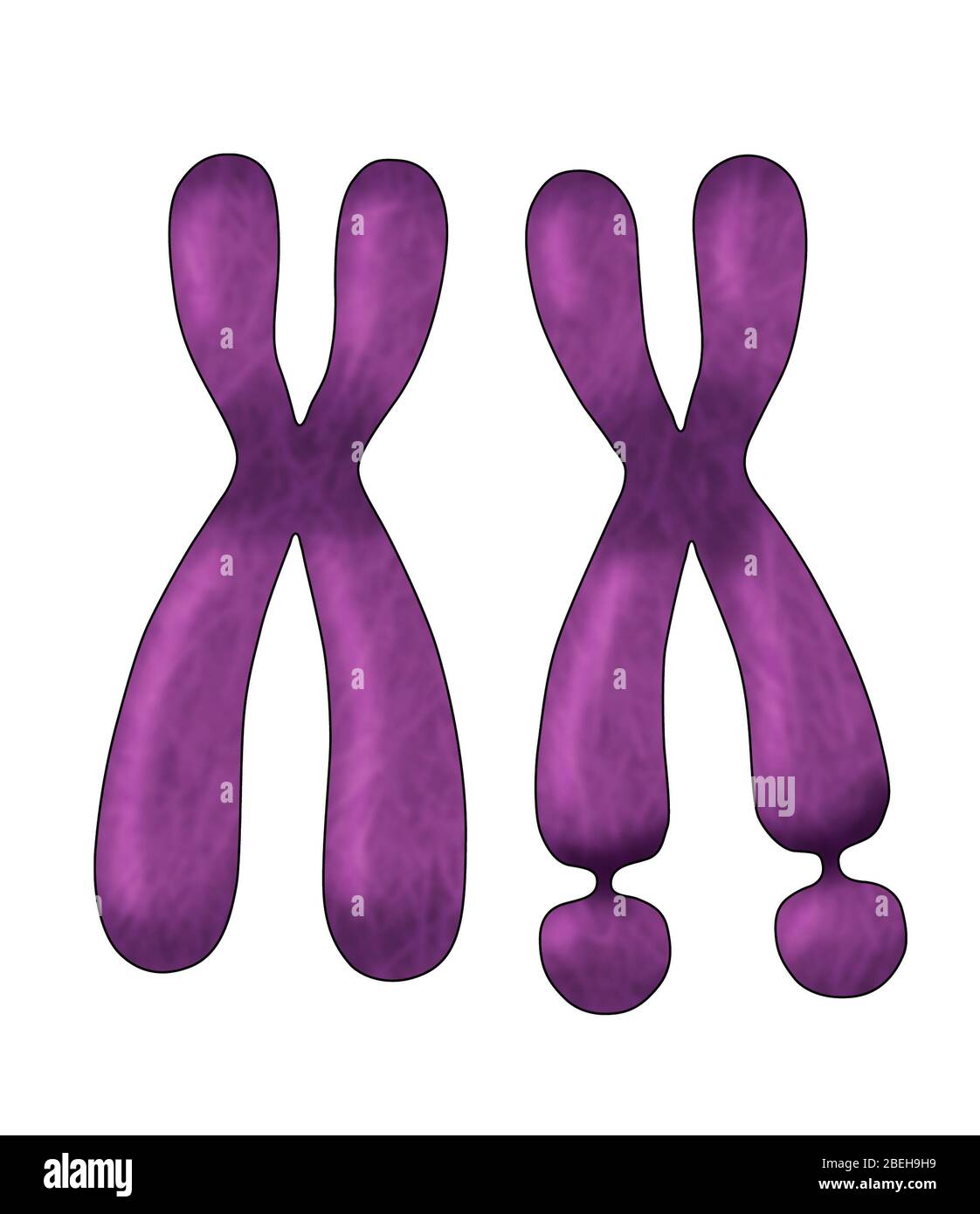 Fragiles X-Chromosom, Abbildung Stockfoto