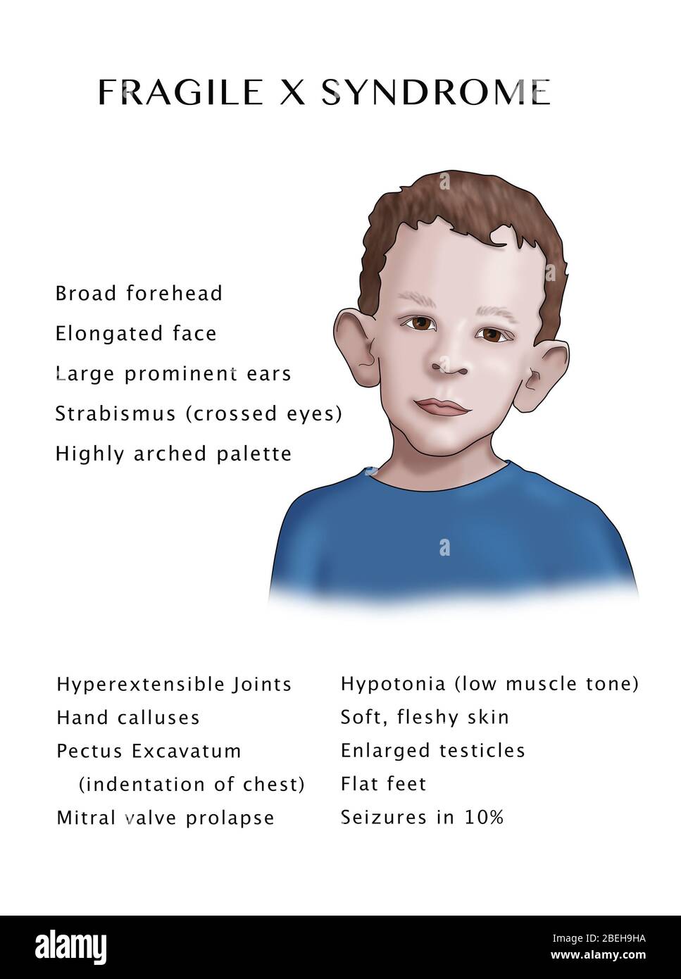 Does Fragile X Cause Autism