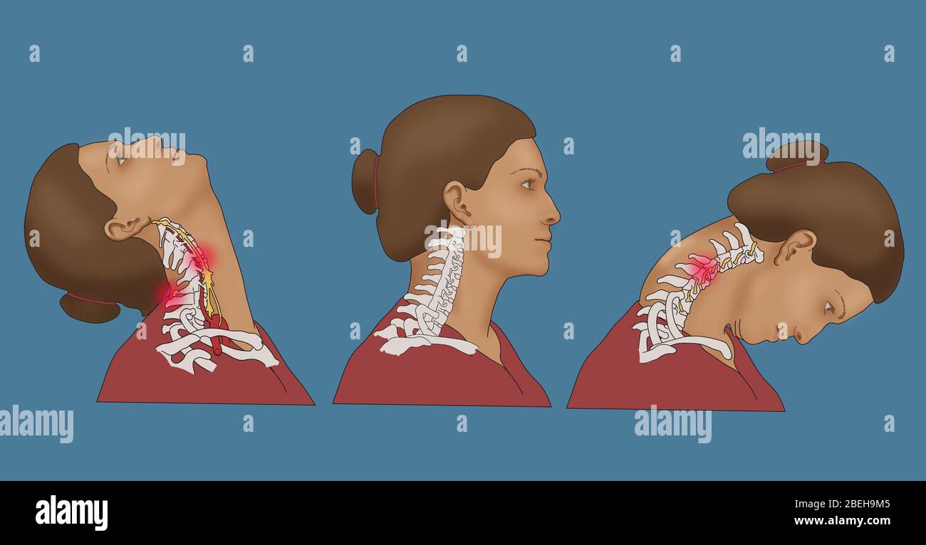 Schleudertrauma, Illustration Stockfoto