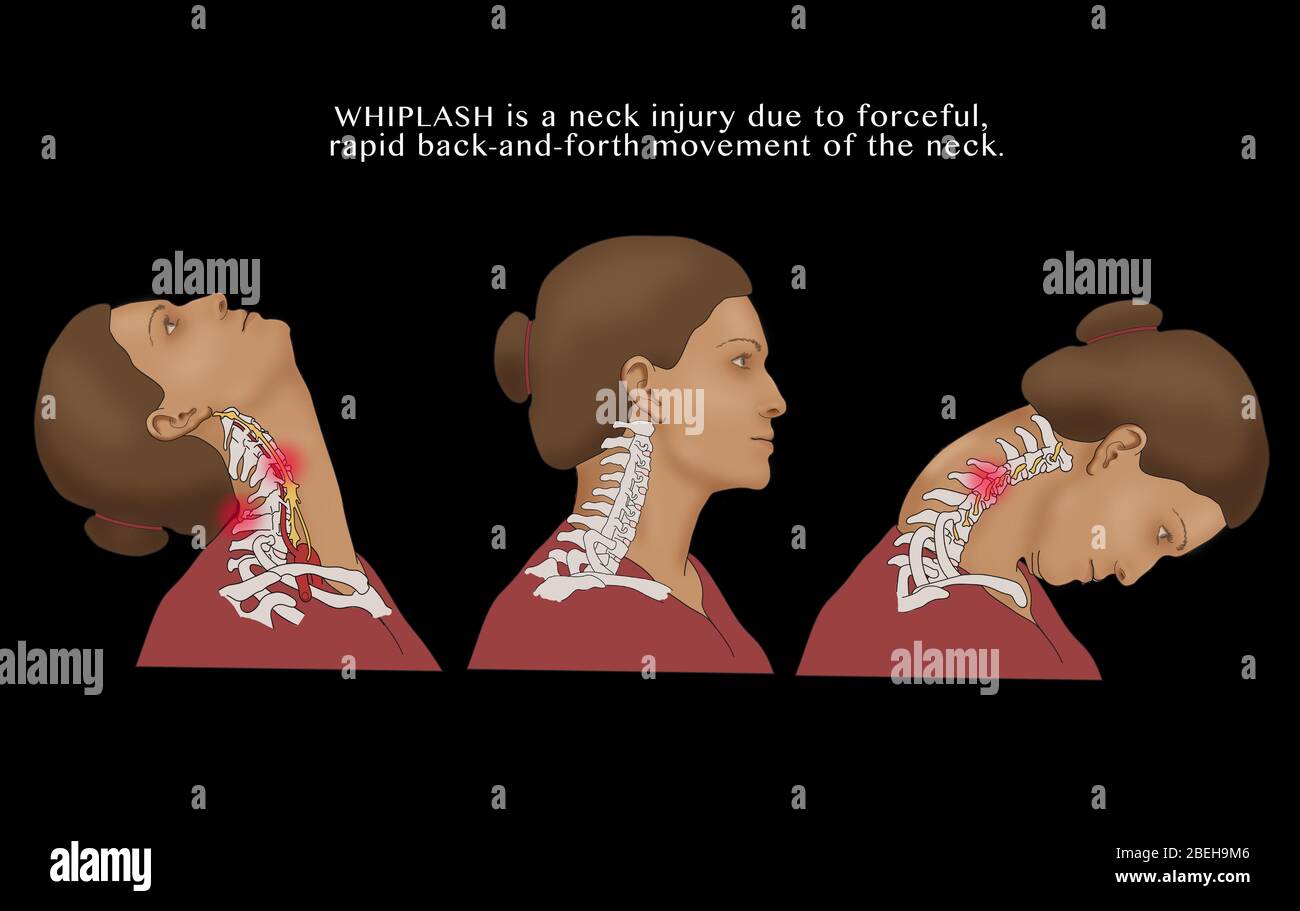 Schleudertrauma. Schleudertrauma tritt meistens während eines realen Selbstunfalls auf, aber die Verletzung kann auch von einem Sportunfall, körperlichem Missbrauch oder anderen Trama resultieren. Abbildung. Stockfoto