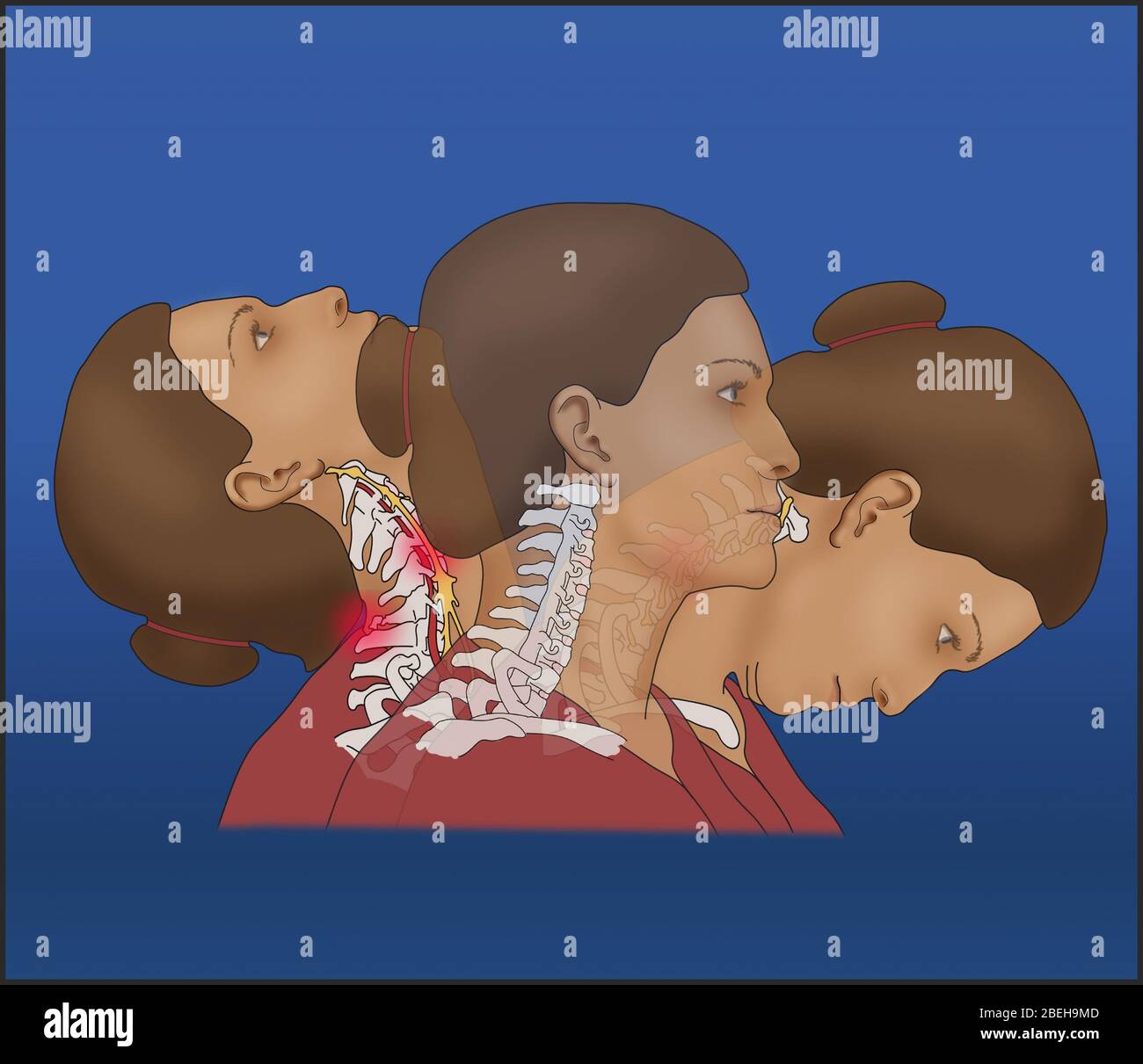 Schleudertrauma, Illustration Stockfoto