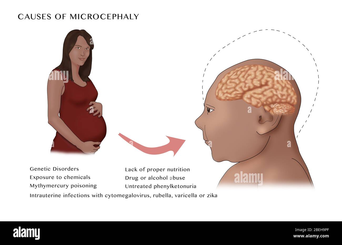 Ursachen der Mikrozephalie, Illustration Stockfoto