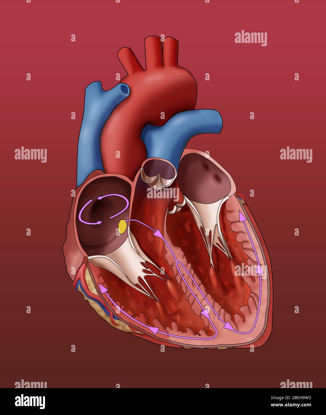 Abbildung eines Herzens, das ein Vorhofflattern, einen anormalen Herzrhythmus, zeigt. Wie hier gezeigt, bewegen sich elektrische Signale innerhalb der Vorhöfe (rosa Kreis) herum und herum; diese kreisenden Signale lassen die Vorhöfe zu schnell schlagen. Stockfoto