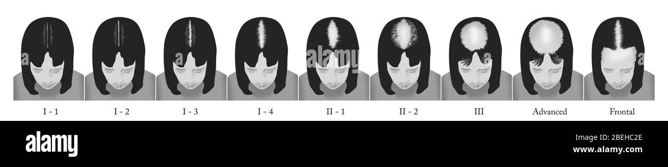Stadien der weiblichen Haarausfall Stockfoto