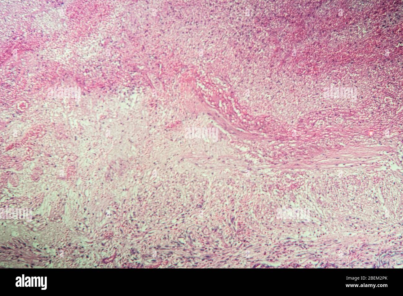 Gallenblase Nekrose Gewebe unter dem Mikroskop 100x Stockfoto