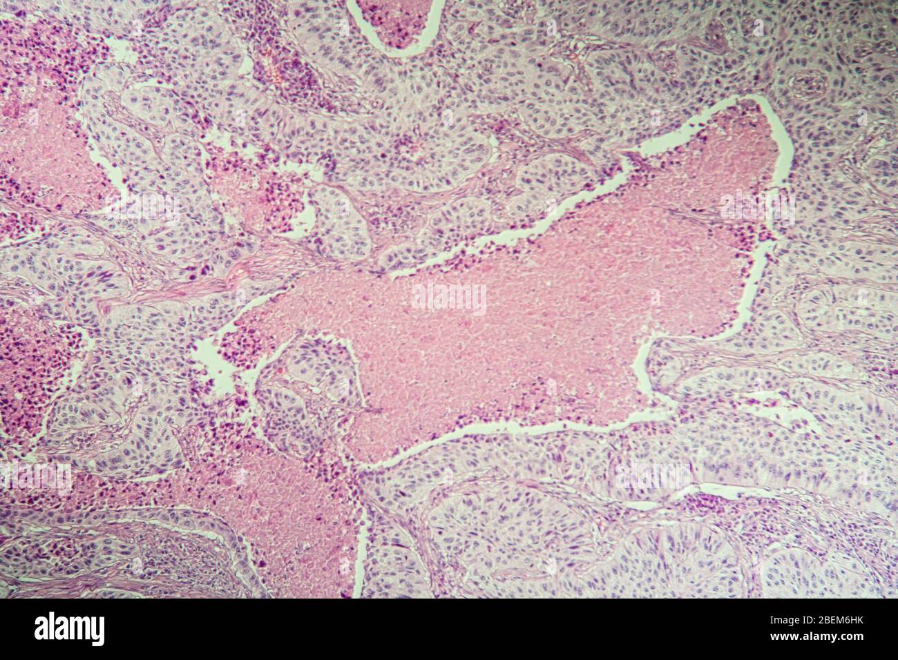 Plattenepithelkarzinom erkranktes Gewebe unter dem Mikroskop 100x Stockfoto