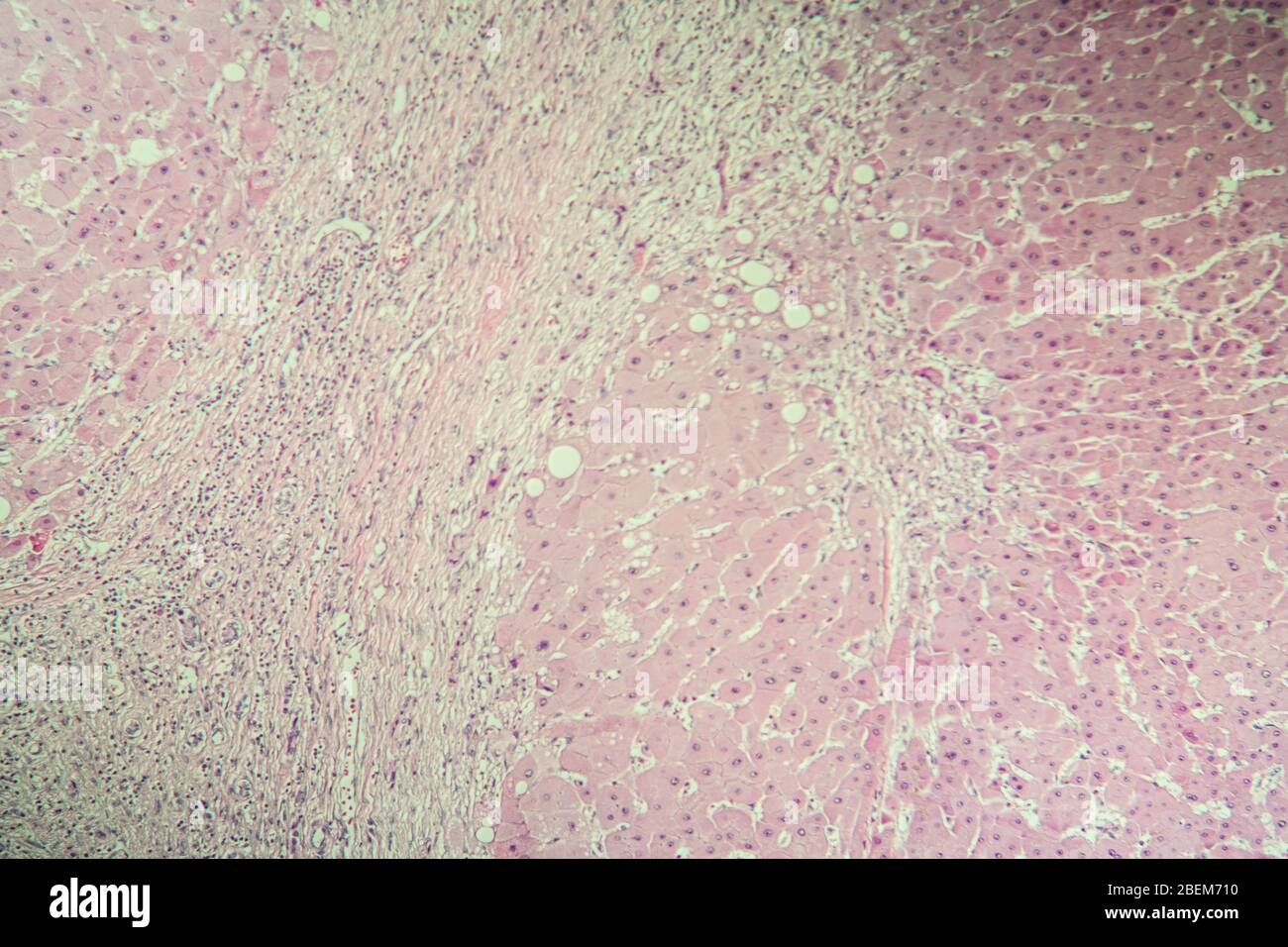 Leberzirrhose erkranktes Gewebe unter dem Mikroskop 100x Stockfoto
