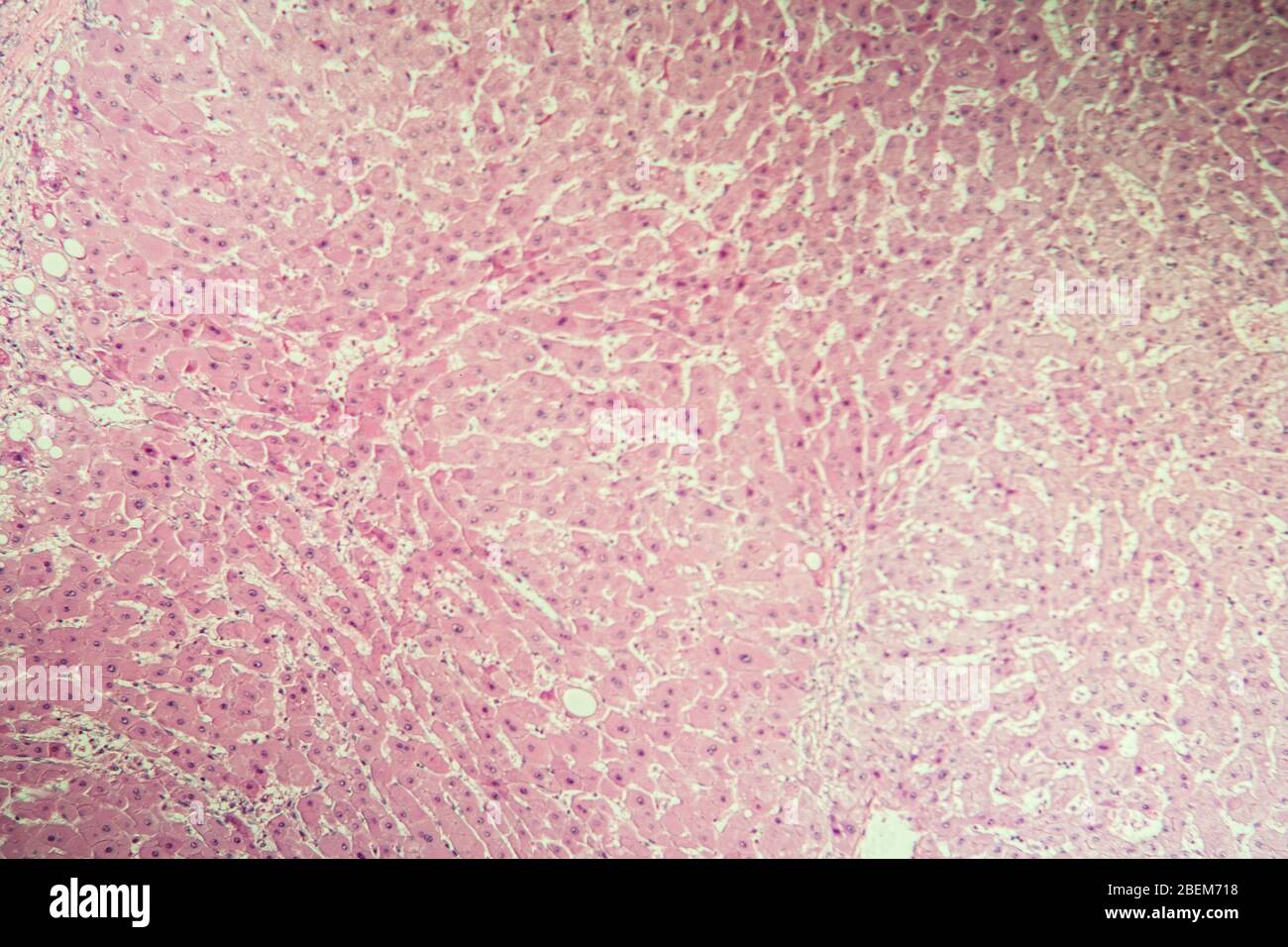 Leberzirrhose erkranktes Gewebe unter dem Mikroskop 100x Stockfoto