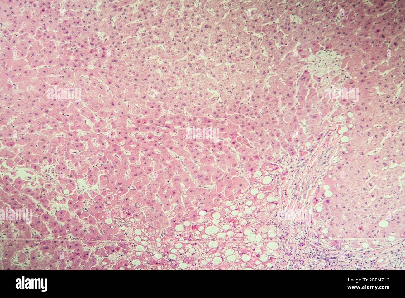 Leberzirrhose erkranktes Gewebe unter dem Mikroskop 100x Stockfoto