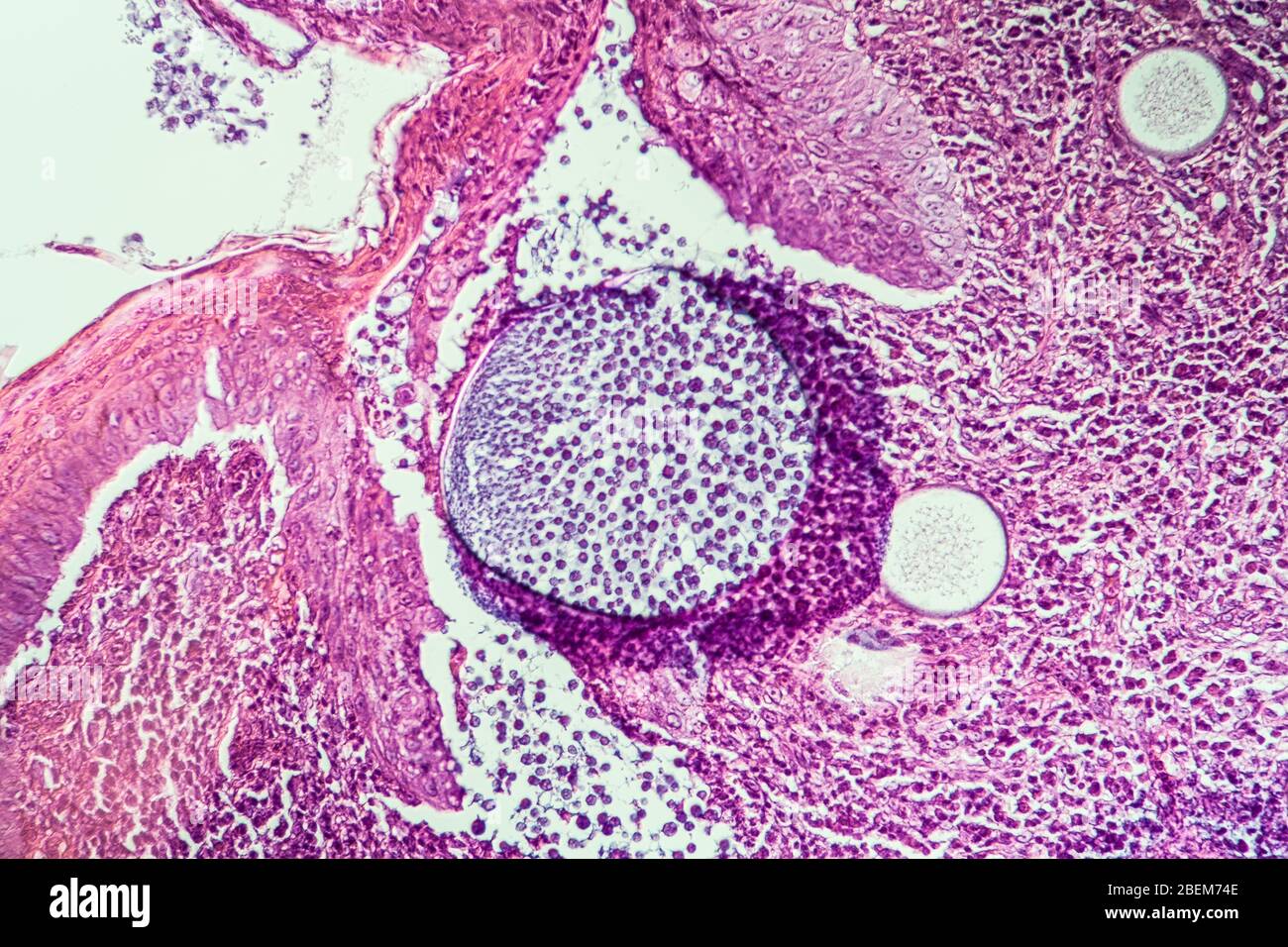 Rhinosporidium Parasit erkranktes Gewebe unter dem Mikroskop 200x Stockfoto