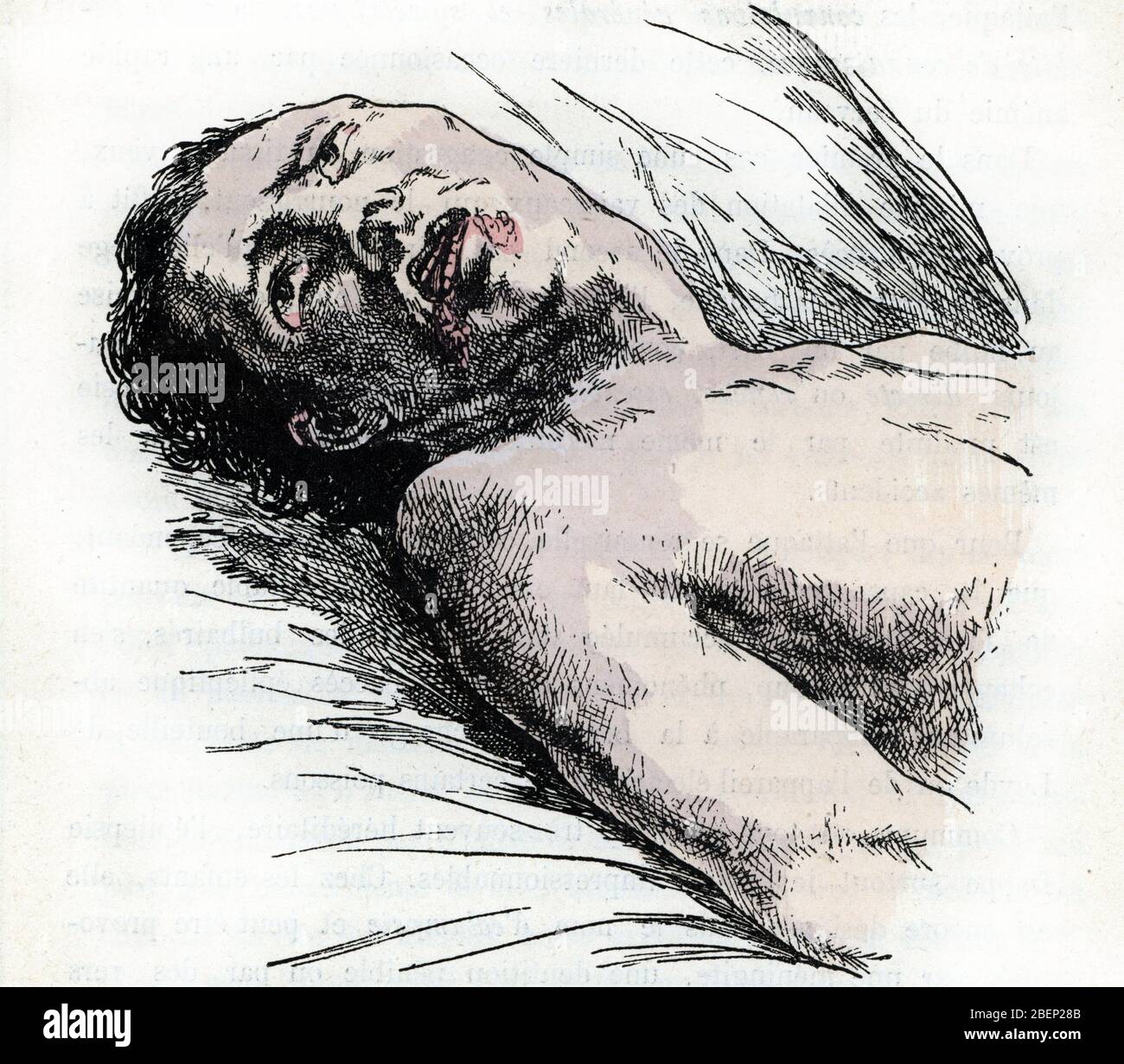 Grand Mal Epilepsie Stockfotos Und Bilder Kaufen Alamy