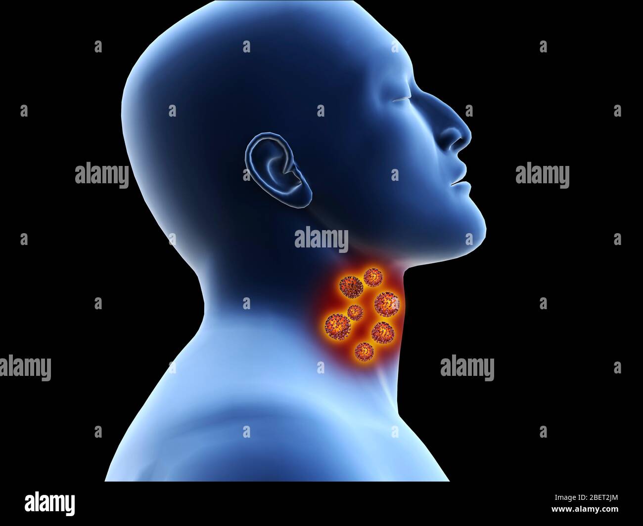Illustratives Konzept des Coronavirus in der menschlichen Kehle, bevor es in die Lunge gelangt. Stockfoto