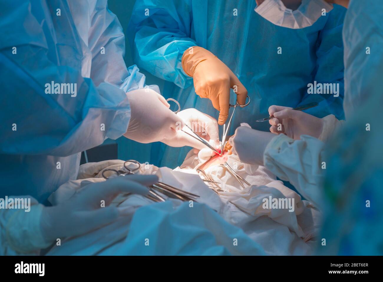 Nahaufnahme, die Hände von Kinderchirurgen und ein Assistent, der einen kleinen Patienten mit einer Hinter-Ohr-Lymphadenitis operiert. In einem sterilen Operationssaal. R Stockfoto