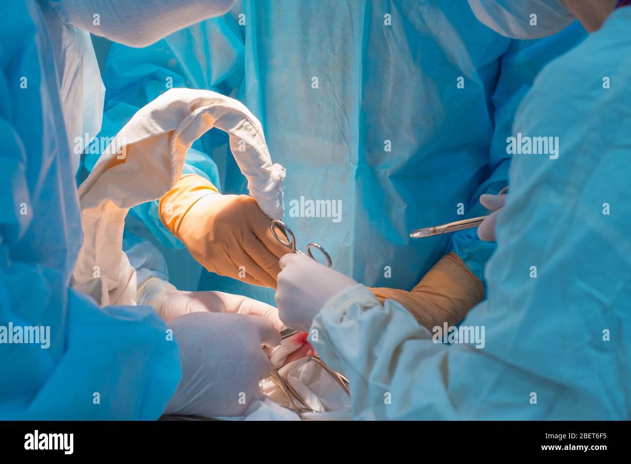 Nahaufnahme, die Hände von Kinderchirurgen und ein Assistent, der einen kleinen Patienten mit einer Hinter-Ohr-Lymphadenitis operiert. In einem sterilen Operationssaal. R Stockfoto