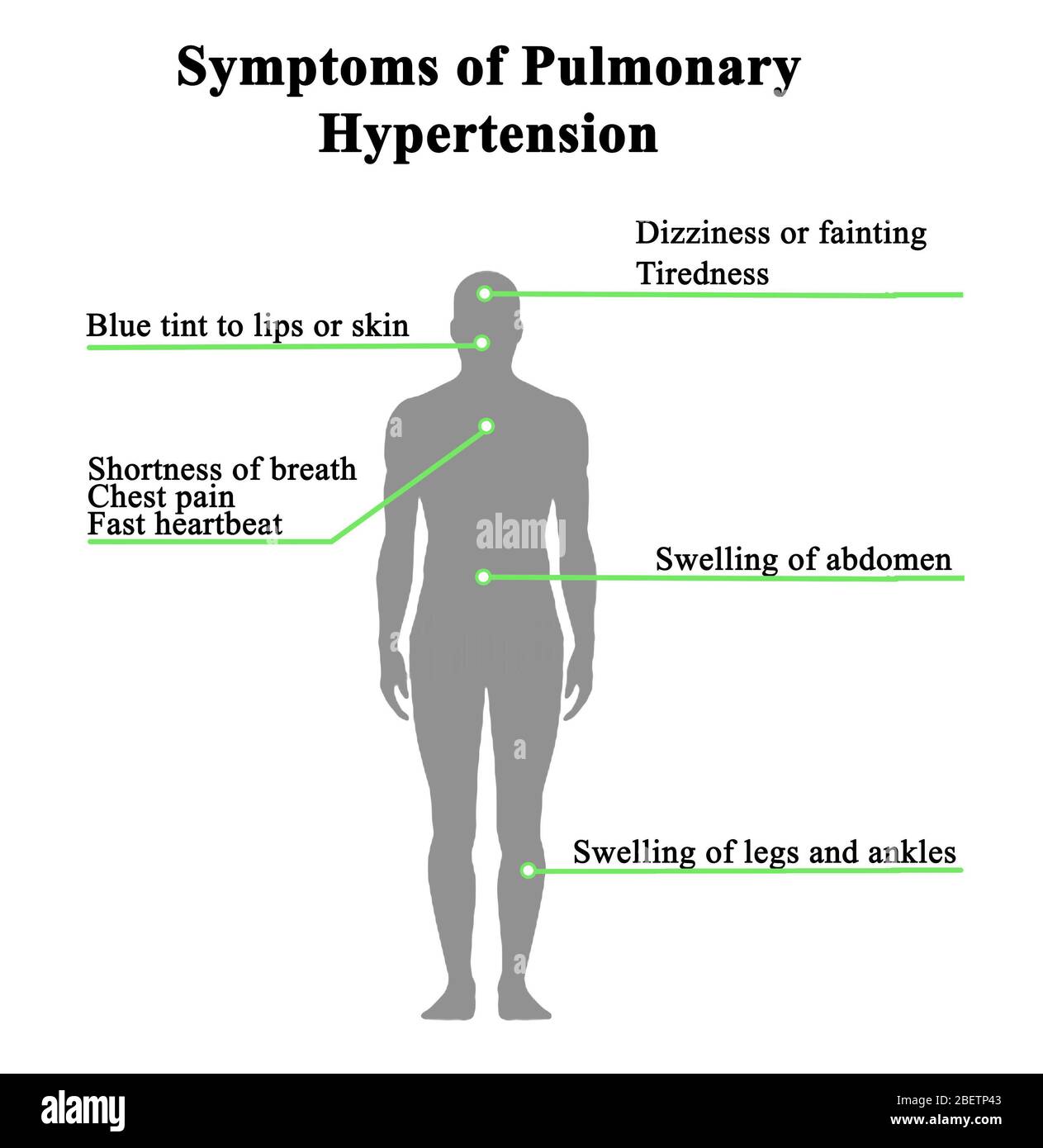Acht Symptome der pulmonalen Hypertonie Stockfoto