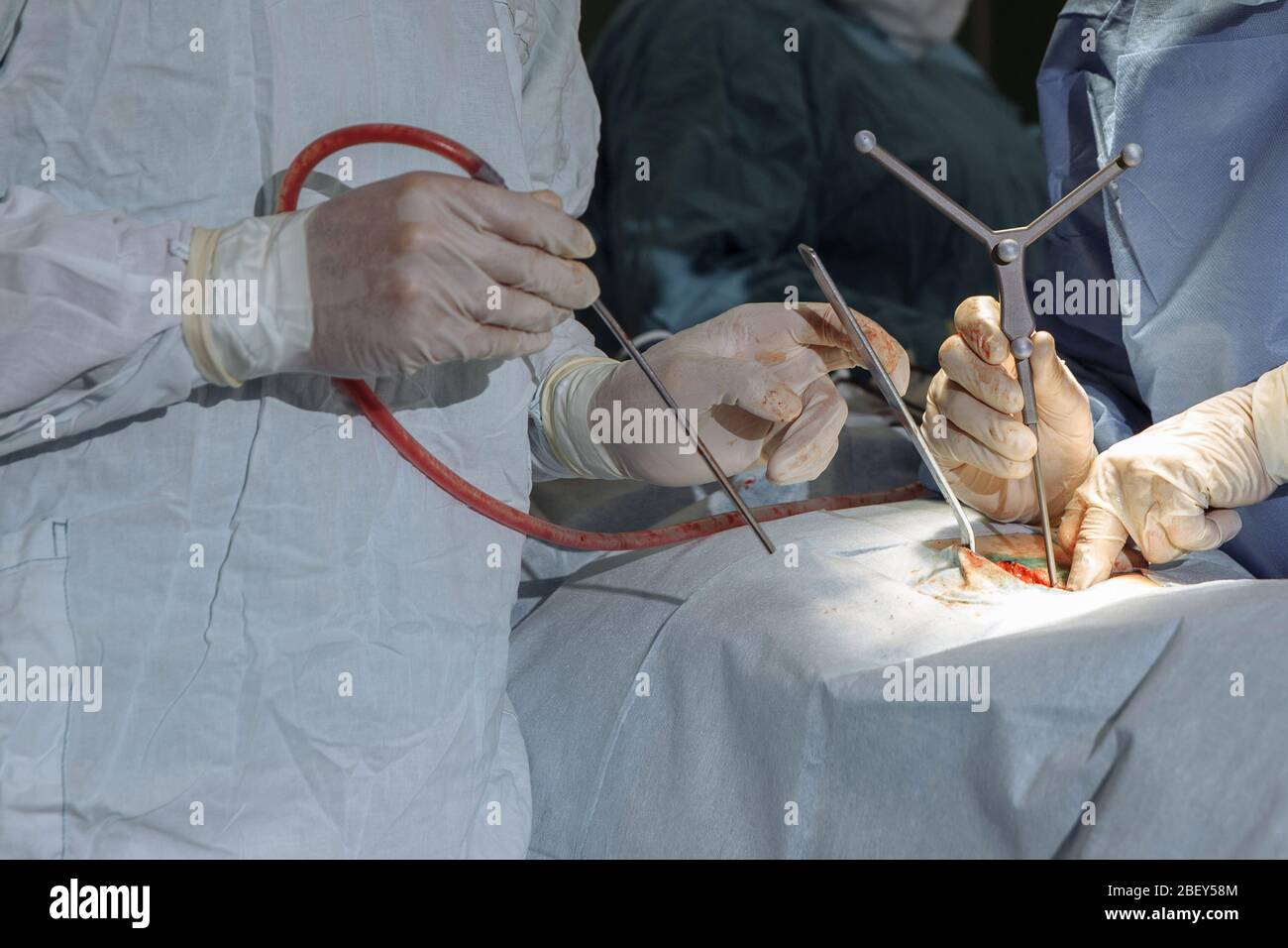 Operation an der Wirbelsäule. Die Hände von Ärzten in medizinischen weißen Handschuhen halten ein chirurgisches Instrument für die Operation. Stockfoto