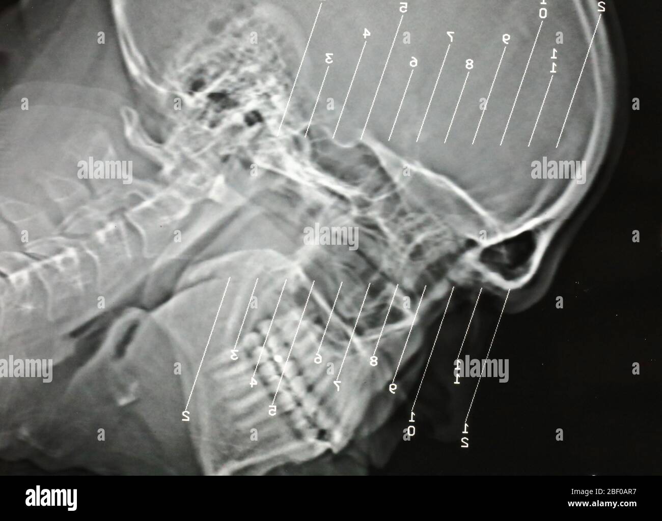 Brain Scan aus einer CAT-Scan Stockfoto