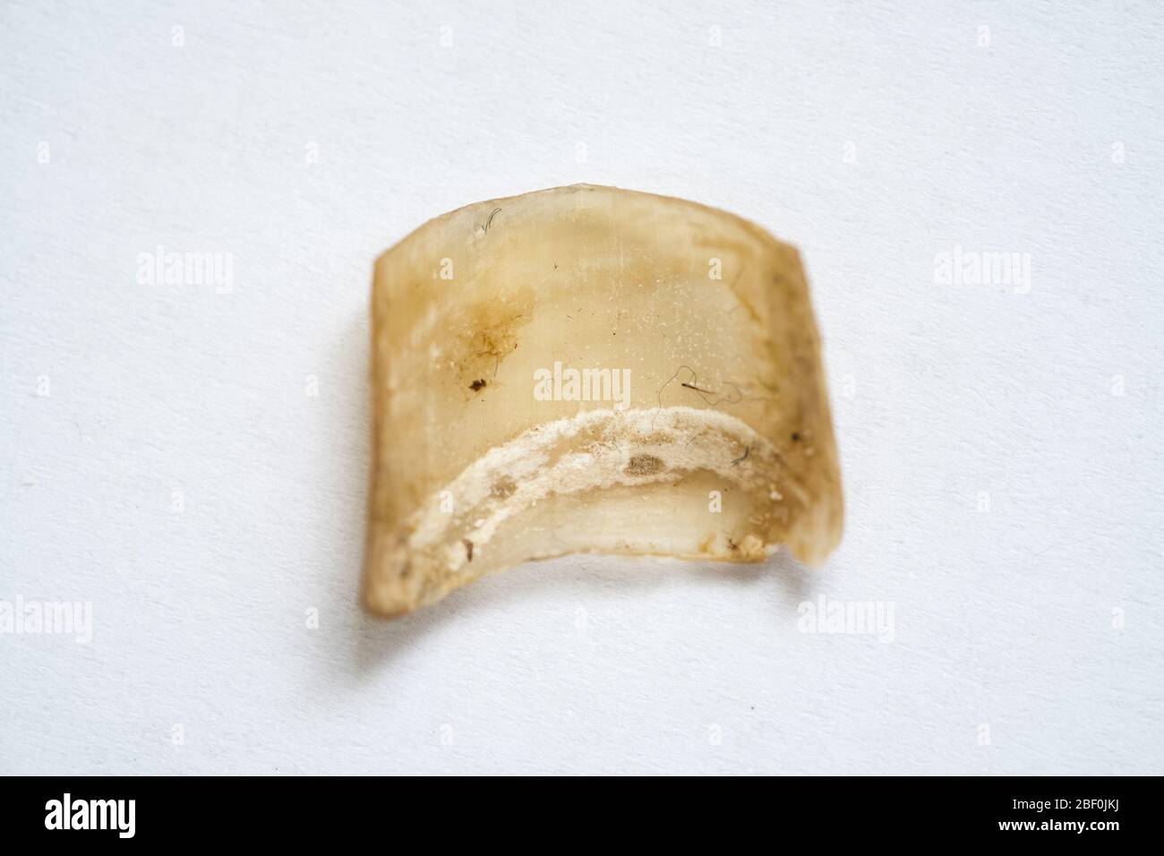 Gebrochene Männliche Fuß Nagel Und Fungal Infektion Stockfoto