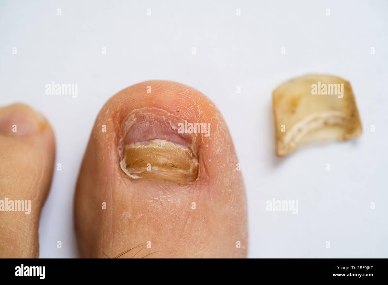 Gebrochene Männliche Fuß Nagel Und Fungal Infektion Stockfoto