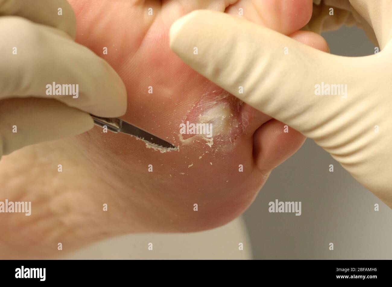 Chiropodist mit einem Skalpell, um gehärtete und versteinerte Haut vom Fuß eines Patienten zu entfernen. Stockfoto