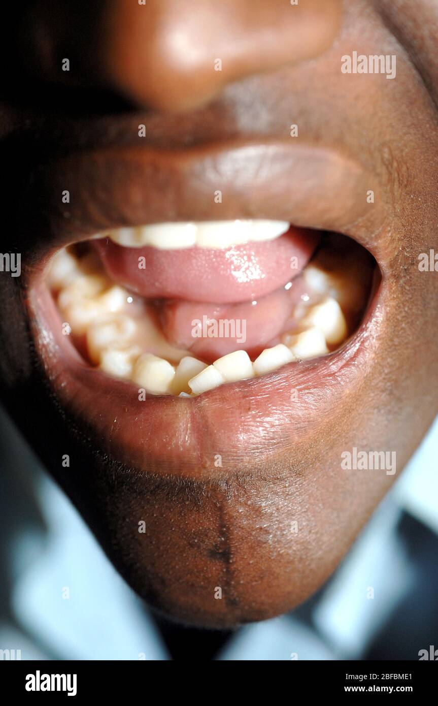 Eumycetom der bukkalen Schleimhaut unter der Zunge des Patienten. Die Schleimhaut der Mundhöhle ist die Schleimhaut der Innenseite der Wange. Eumycetoma ist die Funga Stockfoto