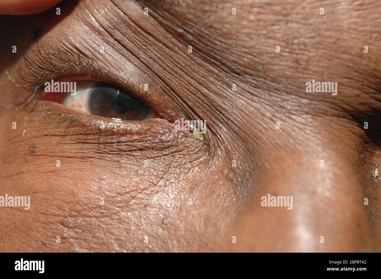 Eine bakterielle oder herpetische Infektion der Tränengänge (Tränengänge oder Canalicula) wird als Canaliculitis bezeichnet. Die Infektion kann Dacryolithen produzieren Stockfoto