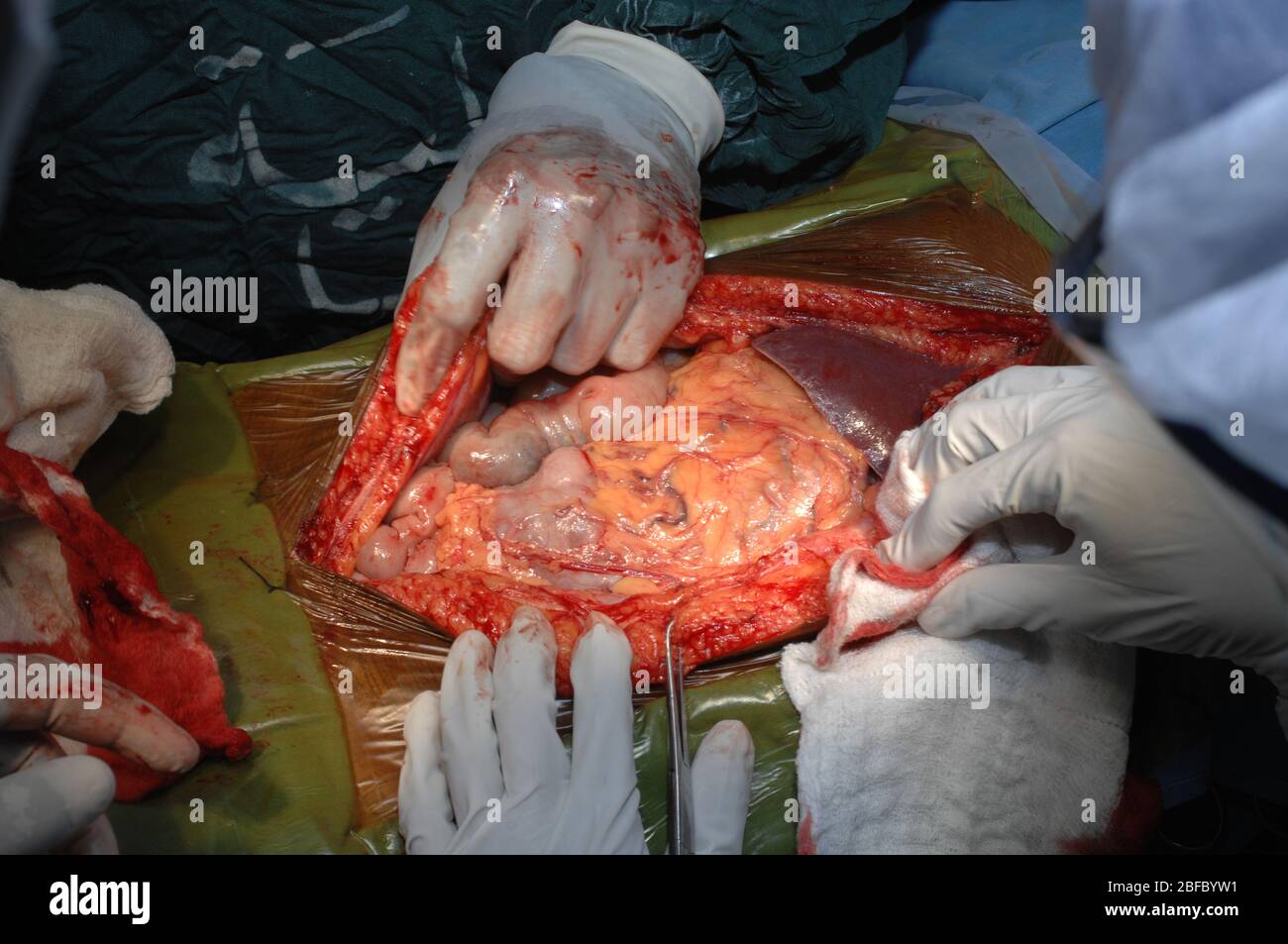 Chirurgen öffnen den Bauch, zeigt die größere Omentum, transversalen Dickdarm und Leber Stockfoto