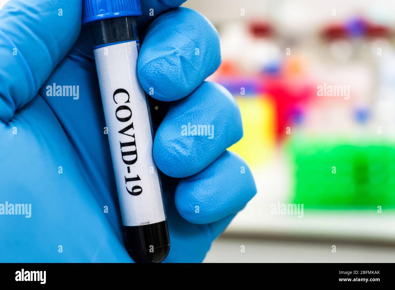 Nachweis des Coronavirus, des Erregers der Krankheit COVID-19. Blutprobe für SARS-CoV-2. Stockfoto