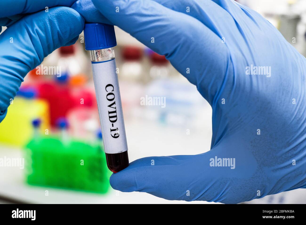 Nachweis des Coronavirus, des Erregers der Krankheit COVID-19. Blutprobe für SARS-CoV-2. Stockfoto
