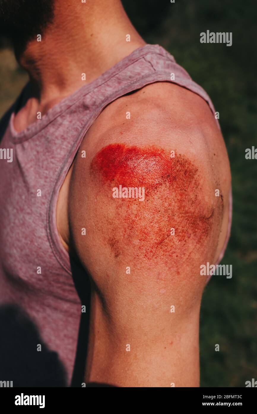 Abrieb an der menschlichen Schulter nach Skateboard Unfall Stockfoto