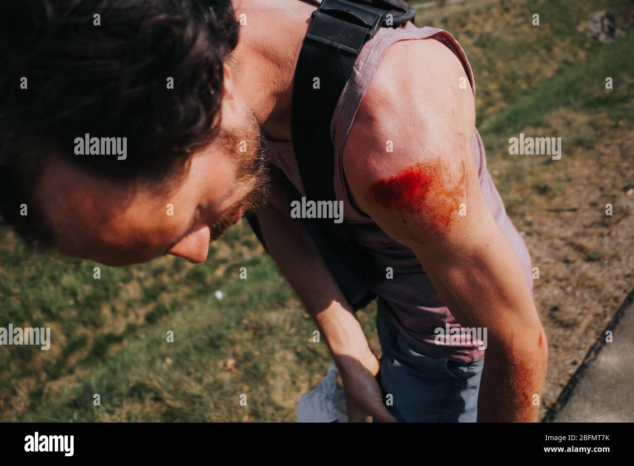 Abrieb an der menschlichen Schulter nach Skateboard Unfall Stockfoto
