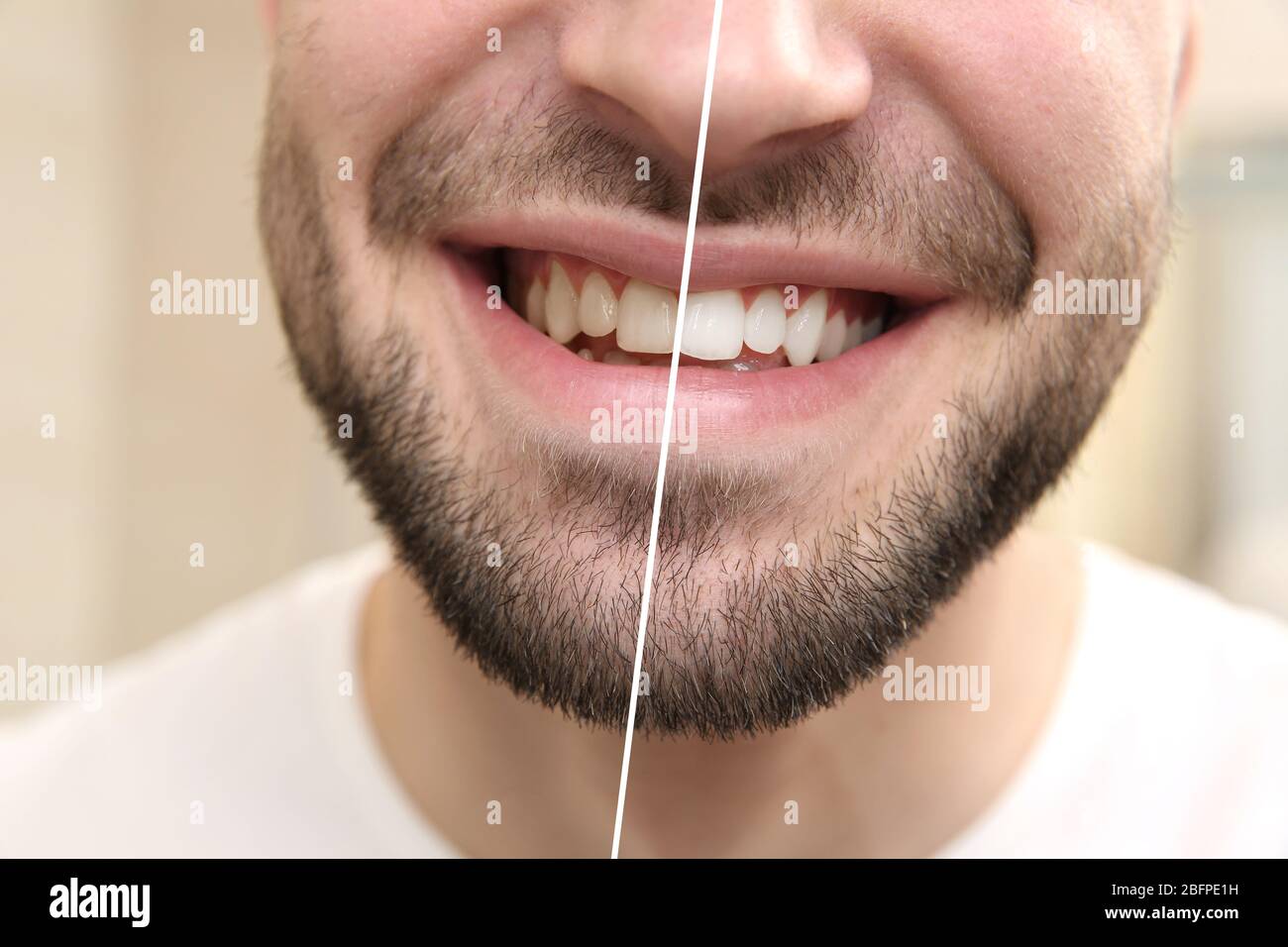 Ergebnis der Zahnaufhellung. Lächelnder junger Mann, Nahaufnahme Stockfoto