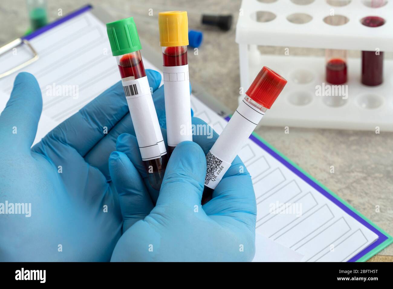 Positiv getestet für das Coronavirus. Medizinische Flasche mit einem Bluttest für das Virus COVID-19 Stockfoto