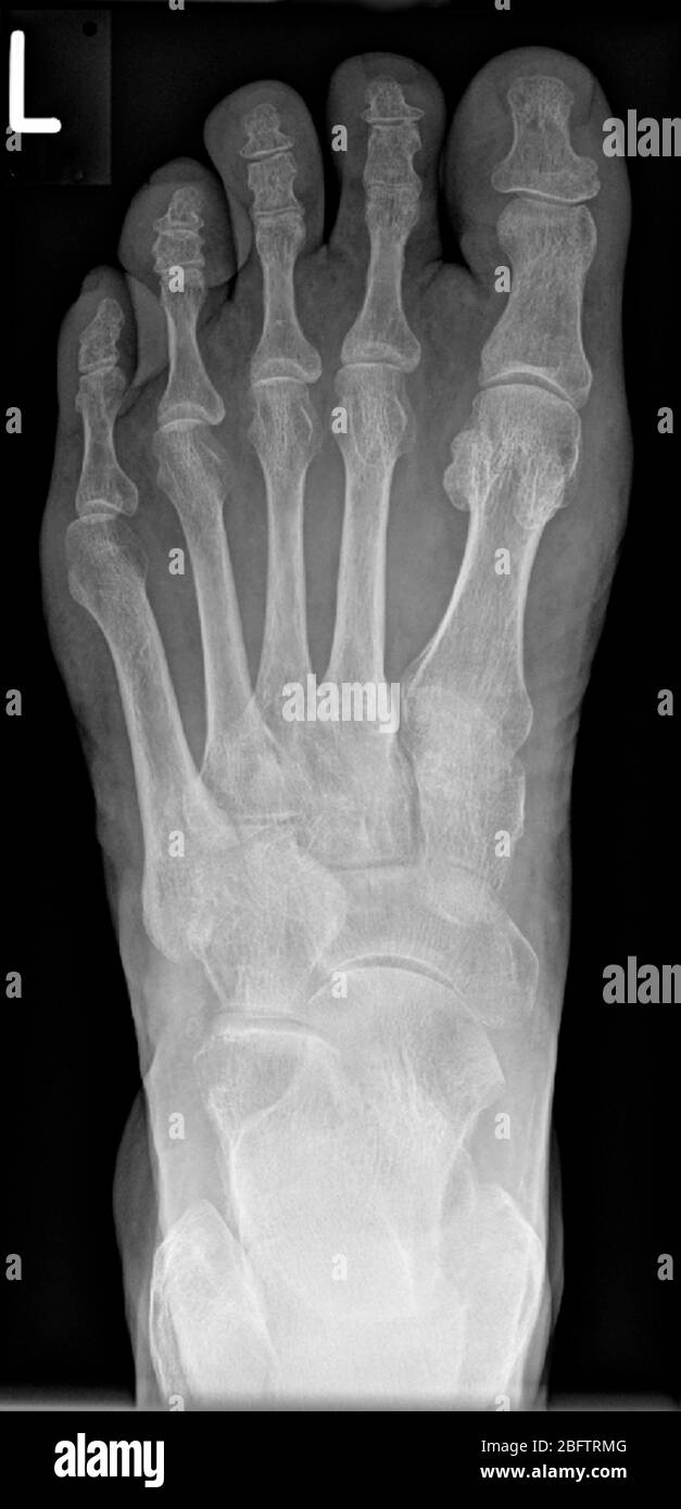 Röntgenaufnahme, linker Fuß mit fortgeschrittener Arthrose, Deutschland Stockfoto