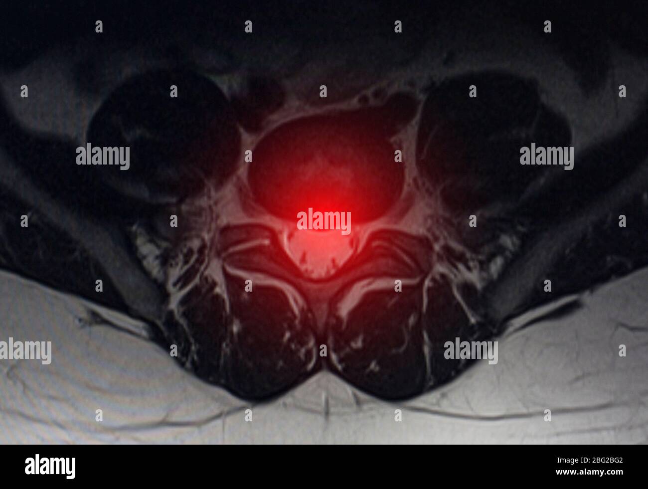 Bild nach Untersuchung der Magnetresonanztomographie. Wirbelsäulenuntersuchung, degenerative Veränderungen der Bandscheiben, Spondylarthrose Stockfoto