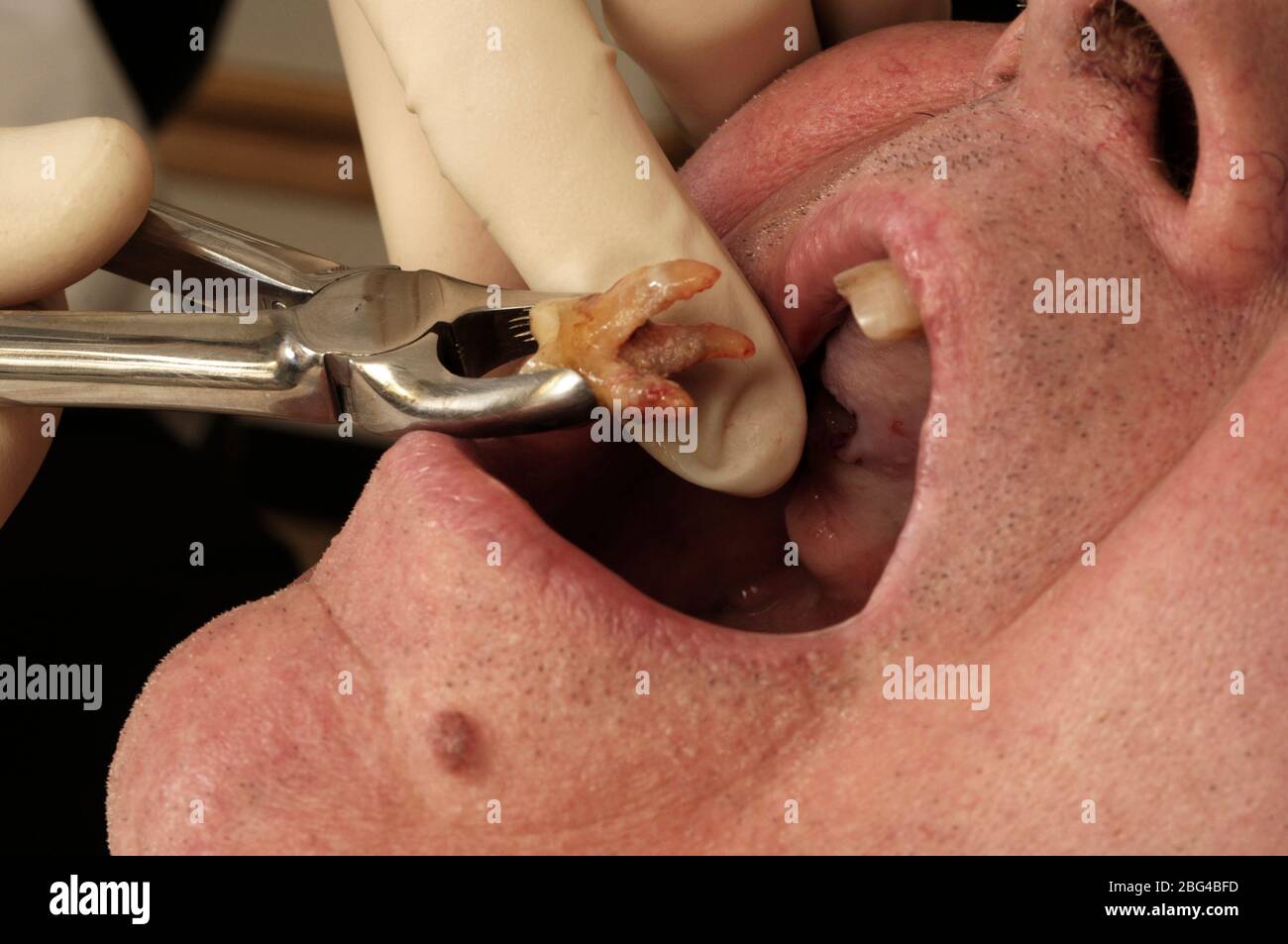Ein Zahnarzt entfernt einen verfallenen Zahn aus dem Mund eines älteren Mannes. Stockfoto