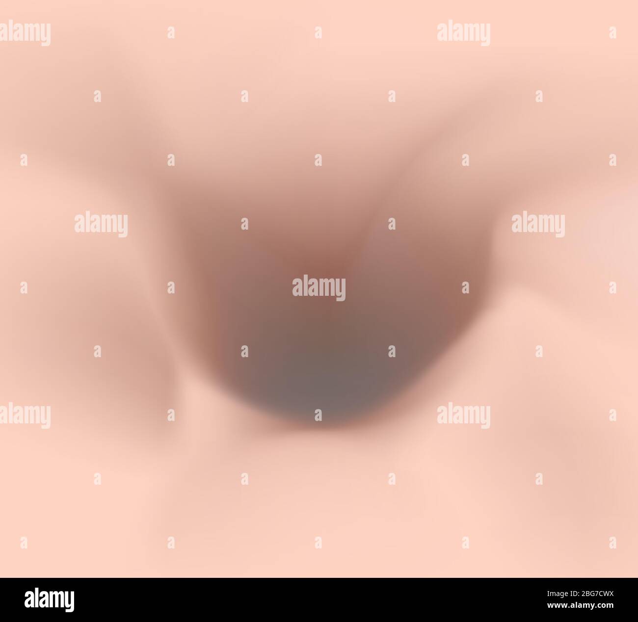 Atrophische Narben. Akne Narbe. Die anatomische Struktur der Haut mit Akne. Vector Illustration auf isolierte Hintergrund. Stock Vektor