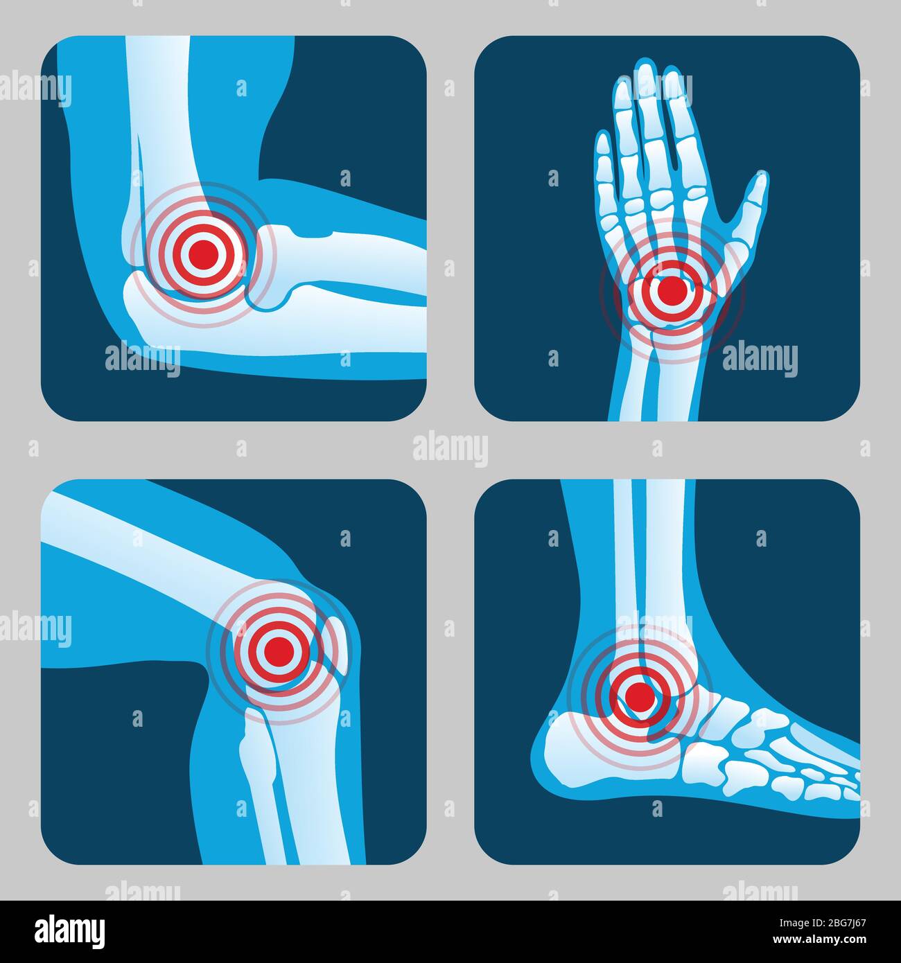 Menschliche Gelenke mit Schmerzringen. Infografik zu Arthritis und Rheuma. Vektorschaltflächen für medizinische Anwendungen. Erkrankungen in Gelenkknochen, Knie, Bein und Hand Illustration Stock Vektor