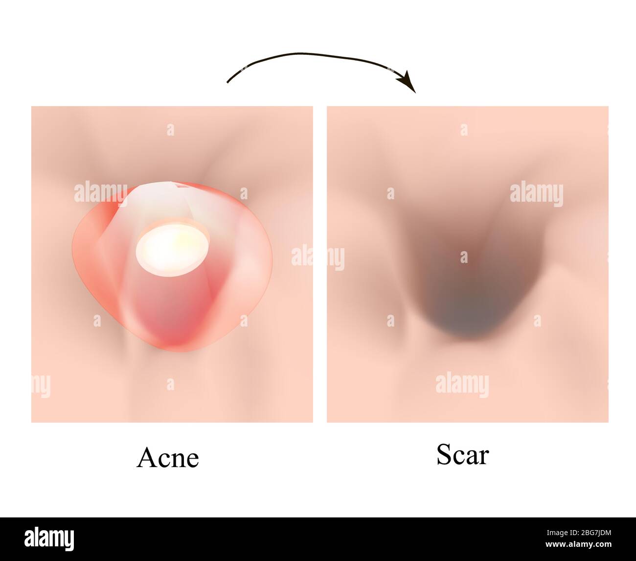 Atrophische Narben. Akne Narbe. Die anatomische Struktur der Haut mit Akne. Vector Illustration auf isolierte Hintergrund. Stock Vektor