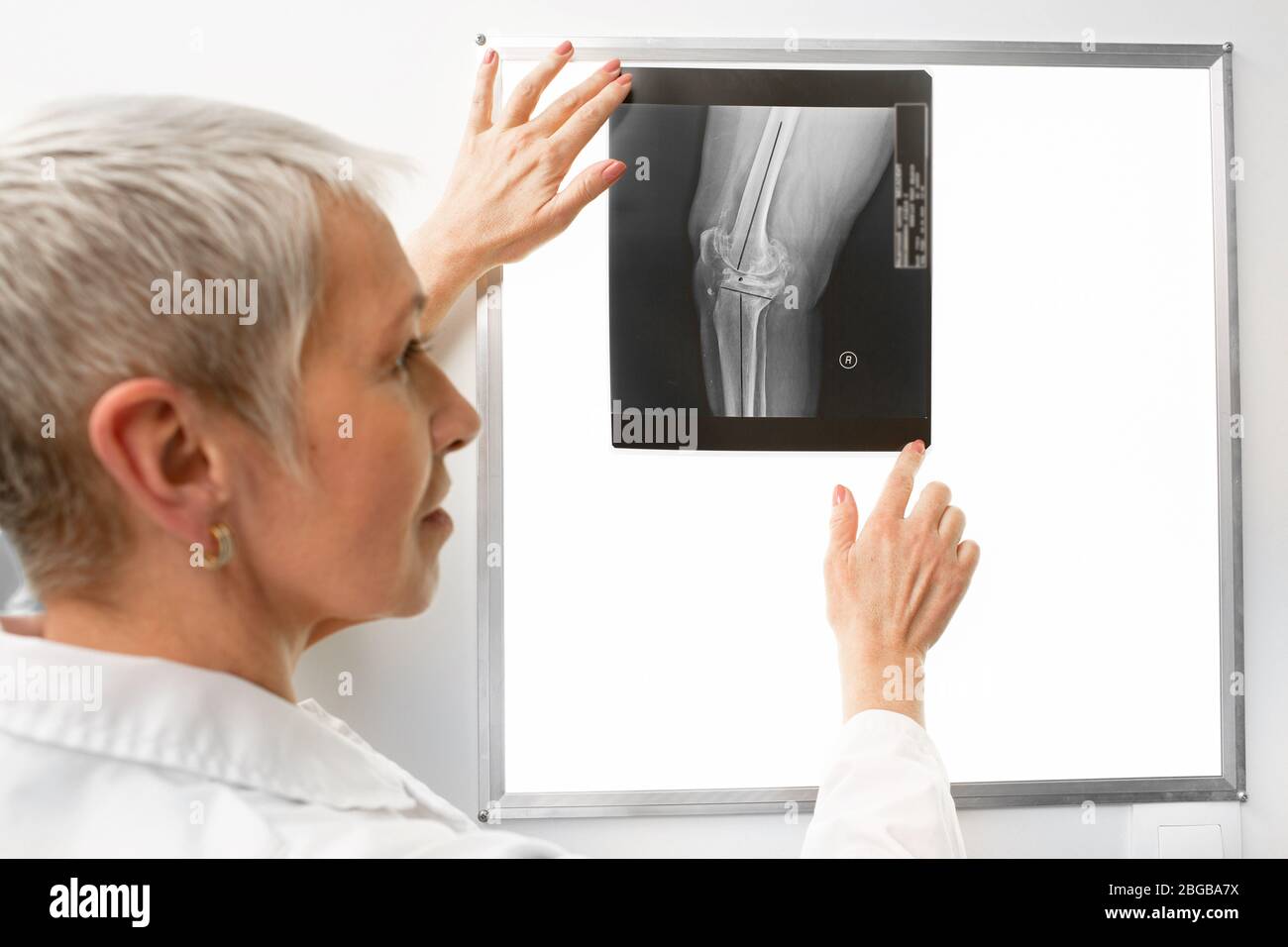 Radiologe untersuchte ein Knieröntgenbild am Negatoskop. Der Arzt sieht auf einem Röntgenfoto ein geprelltes Bein Stockfoto