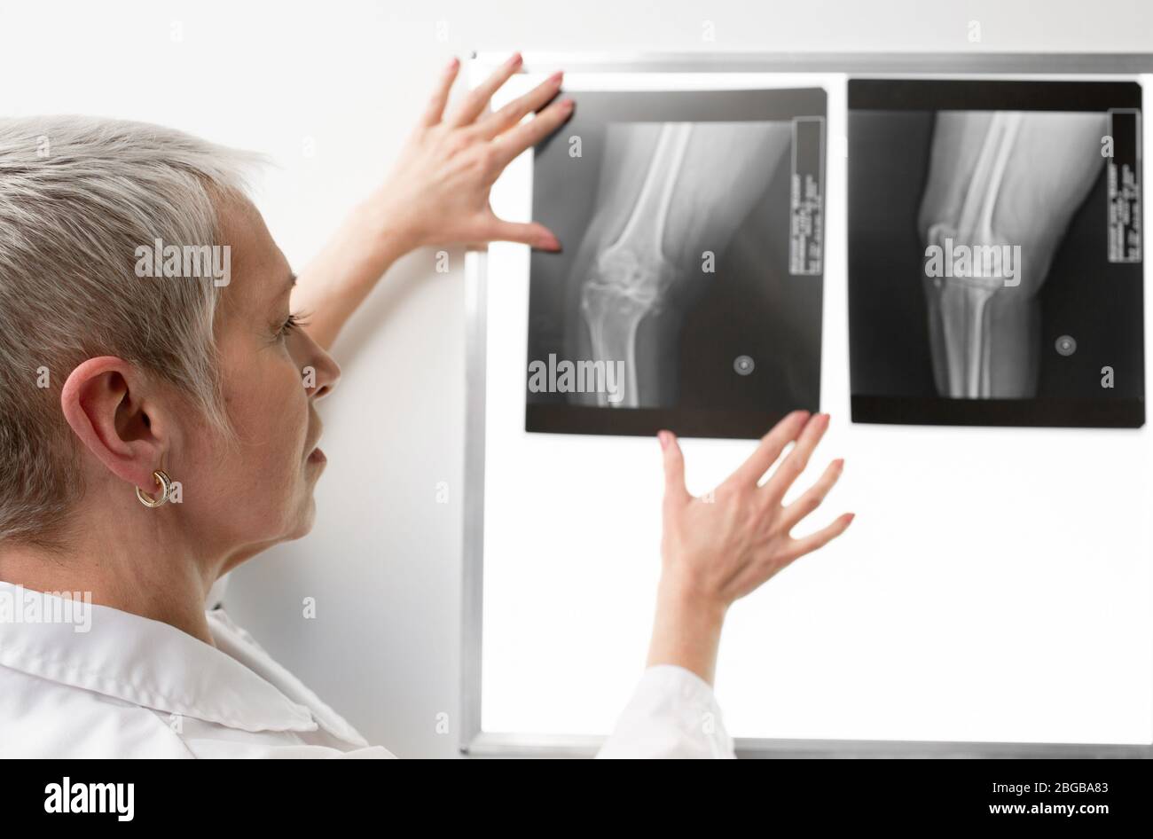 Der Radiologe untersucht eine Kniescheibe auf einem Negatoskop. Der Röntgenarzt sieht das Band am Knie des Patienten Stockfoto