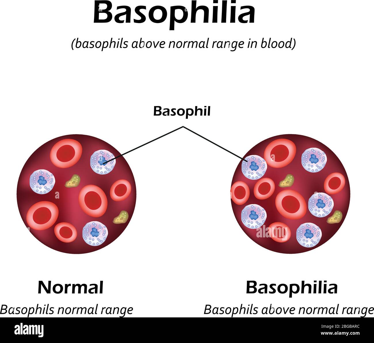 Basophile über dem Normalbereich im Blut. Basophilie. Infografiken. Vektorgrafik Stock Vektor