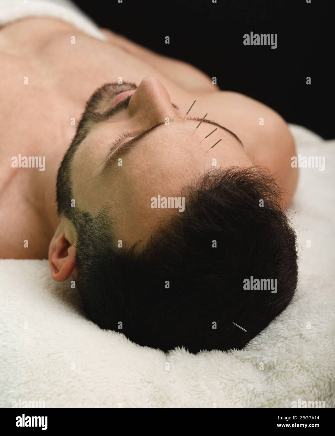 Antistress. Akupunktur des Kopfes eines Mannes hilft, Migräne loszuwerden. Alternative Medizin Stockfoto