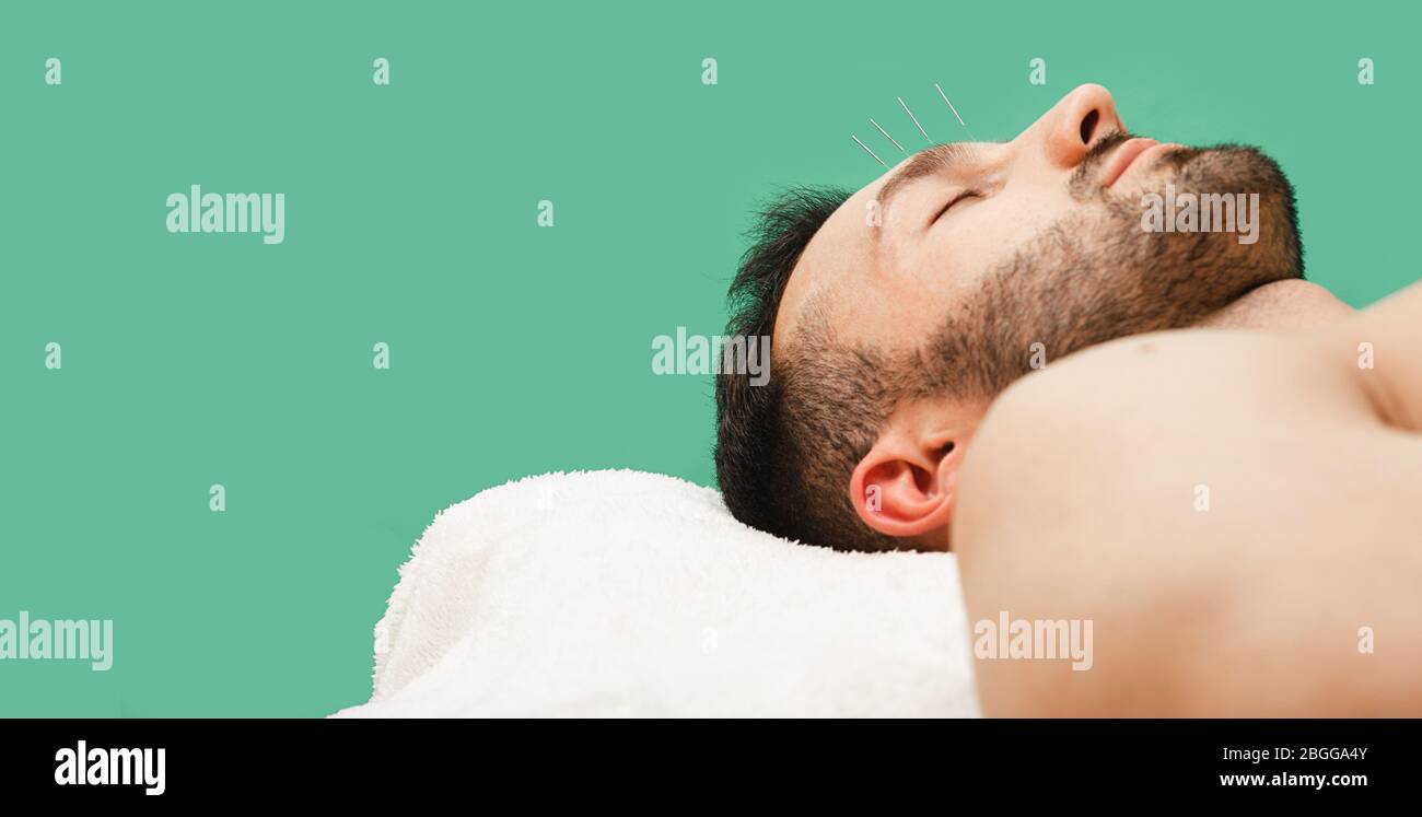 Akupunkturnadeln zur Behandlung von Kopfschmerzen eines Mannes. Traditionelle chinesische Medizin Stockfoto